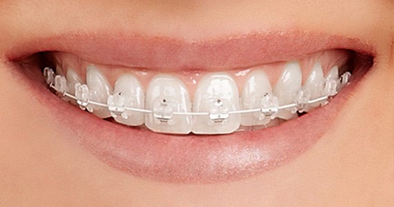 Aparaty ortodontyczne Staszów  Świętokrzyskie