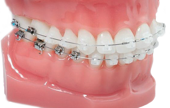Ortodonta Staszów  Świętokrzyskie - Aparaty ortodontyczne działanie aparatu