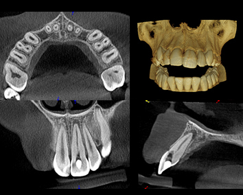Szybka ortodoncja Ortodonta Staszów Świętokrzyskie ​Diagnostyka ortodentyczna Staszów Obrazowanie tomografia 3D