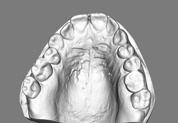 ​Ortodonta Staszów Świętokrzyskie Wycisk cyfrowy uzębieniaontycznyetria