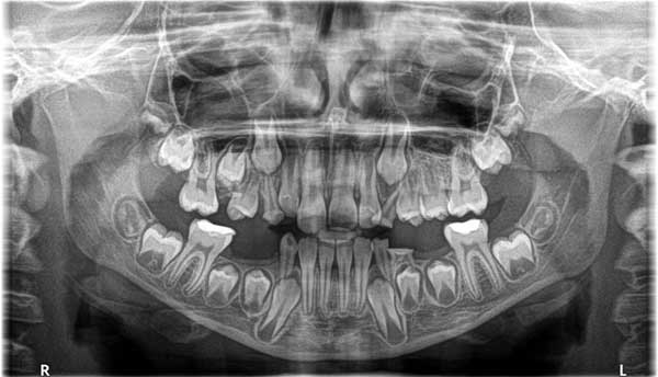 Szybka ortodoncja Ortodonta Staszów Świętokrzyskie ​​Diagnostyka ortodentyczna Staszów Zdjęcie RTG PA