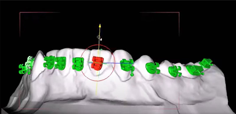 Ortodonta Staszów Świętokrzyskie Skaner ortodontyczne 3D ​Ortodonta Staszów Aparaty projektowane