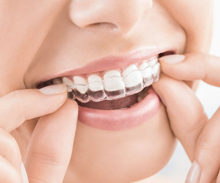 ​Ortodonta Staszów -Świętokrzyskie Leczenie nakładkami